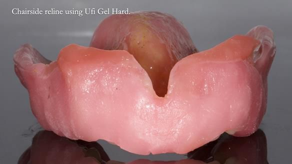 Newsletter 77: Jeremy’s case – immediate complete upper denture