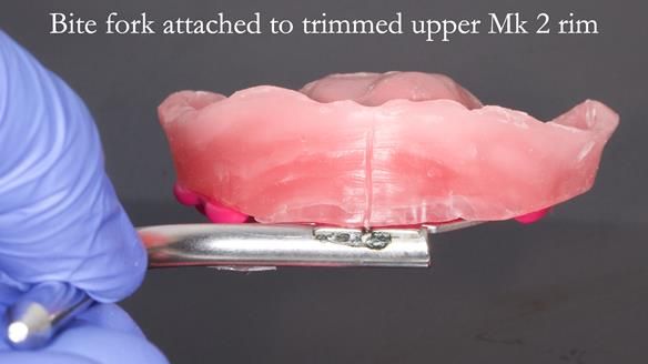 Newsletter 52 Managing Jo’s failing dentition with extractions and Mk 1/Mk 2 complete upper dentures and lower partial dentures FULL PROTOCOL