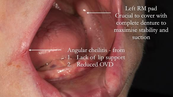 Newsletter 75: Marion’s case - Step-by-step complete denture workflow