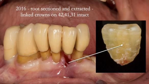 Ken – going downhill, first class