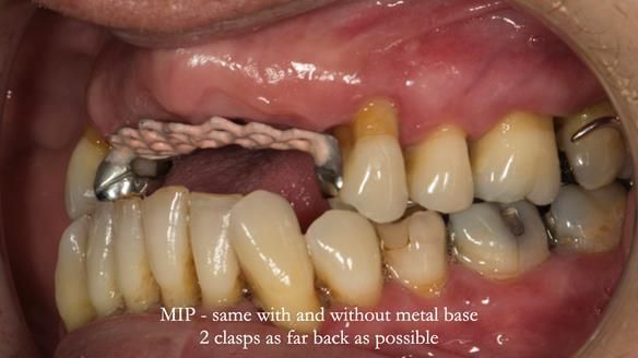 Finlay's Newsletter 63 Case study provision of metal based Scandinavian RPD - functional 10 years on