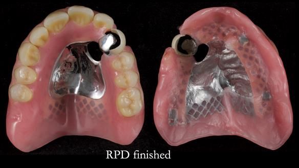 Newsletter 55 Provision of metal based partial dentures for Zephyrine with a repaired cleft lip and palate