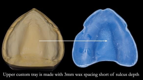 Newsletter 77: Jeremy’s case – immediate complete upper denture