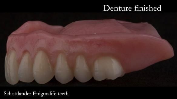 Newsletter 75: Marion’s case - Step-by-step complete denture workflow