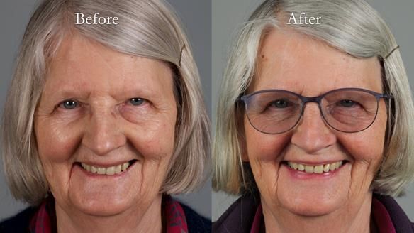 Newsletter 82 Mary - A complete upper and a one-tooth gasket denture