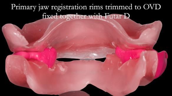Newsletter 52 Managing Jo’s failing dentition with extractions and Mk 1/Mk 2 complete upper dentures and lower partial dentures FULL PROTOCOL