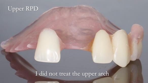 Newsletter 44 - extreme removable prosthodontics – engineering a super-strong and ultra-thin over denture