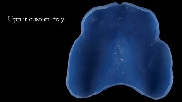 Newsletter 77: Jeremy’s case – immediate complete upper denture