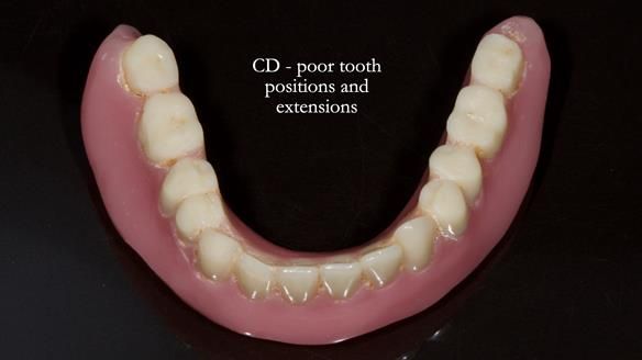 Newsletter 83: Sheila’s Complete Denture Success