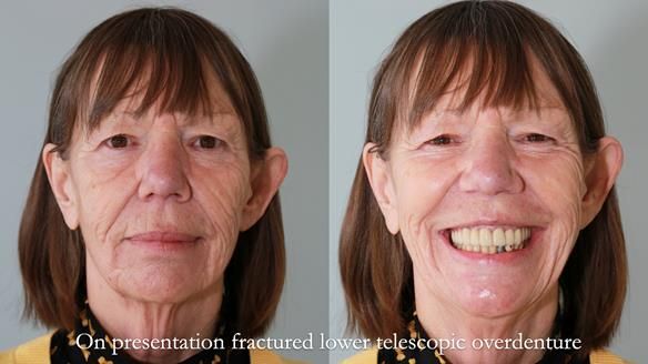 Newsletter 76: Jackie’s case – Telescopic overdenture & precision RPD (the tricky truth!)