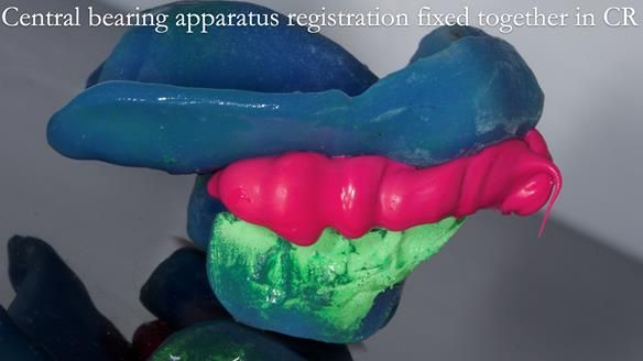 Newsletter 77: Jeremy’s case – immediate complete upper denture