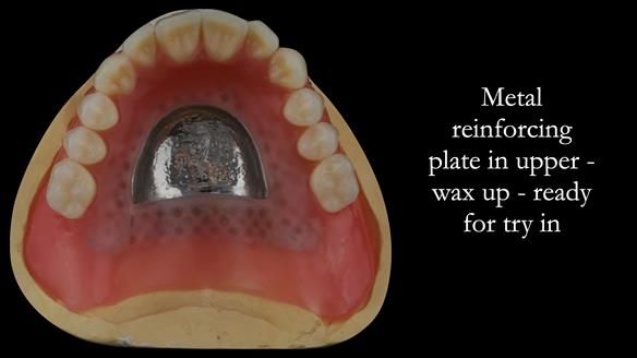 Wax try in. Reinforcement to the opposing dentures is also crucial to reduced breakages