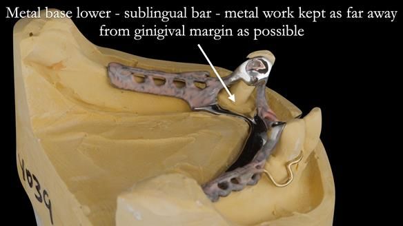 Finlay's Case Study Newsletter 40 - Immediate Mk 1 RPD to Definitive Mk 2 RPD - full protocol