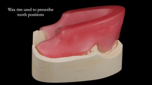 Newsletter 77: Jeremy’s case – immediate complete upper denture