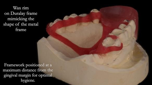 Finlay's Newsletter 64 case study - provision of a Kennedy class 2 metal based Scandinavian RPD for Ian