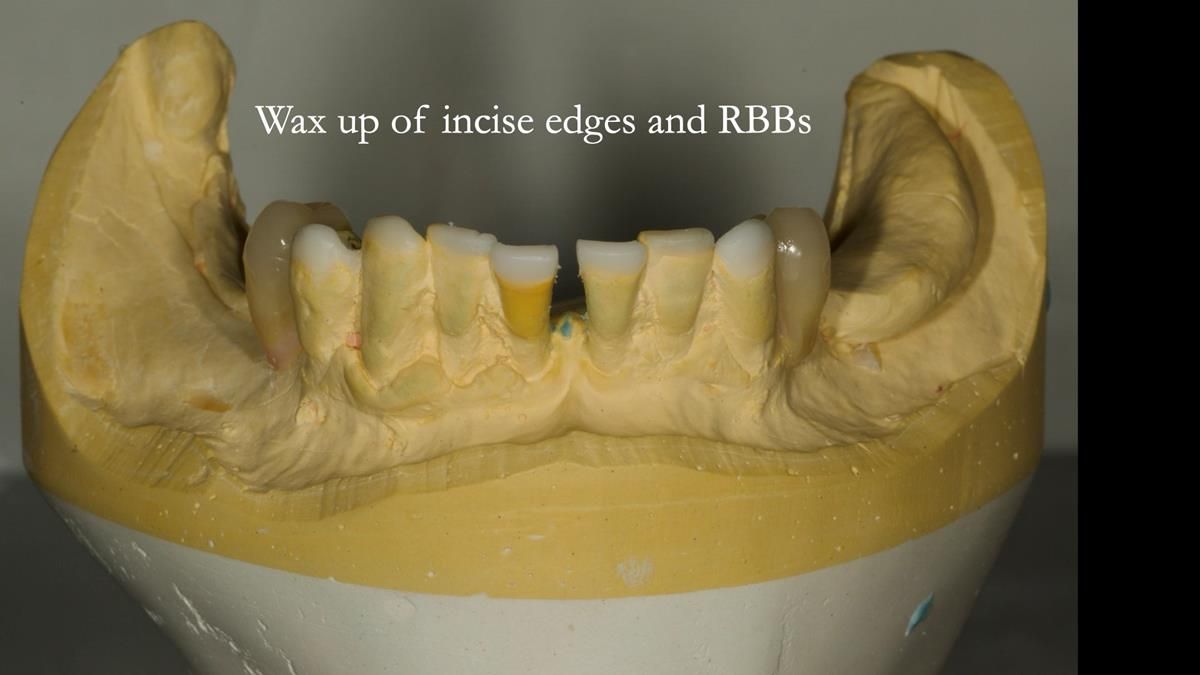 Newsletter 87 – Father Peter: A Partial Denture that needed Minor Miracle