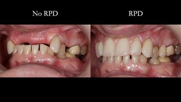 Newsletter 81 - Pam’s Story — how a partial denture changed her life (+ live walkthrough this Thursday)