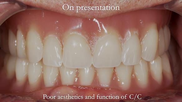 Newsletter 50 Special edition Complete Dentures FULL PROTOCOL