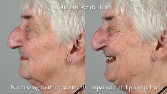 Newsletter 55 Provision of metal based partial dentures for Zephyrine with a repaired cleft lip and palate