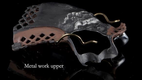 Finlay's Newsletter 59 Ultra hard partial dentures made for Gill