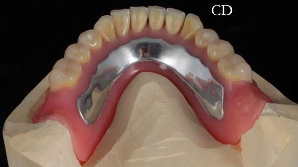 Finlay's Newsletter 62 provision of extractions and metal based complete dentures for Rafique