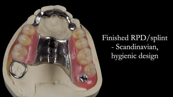 Finlay's Newsletter 60 Sylvia's upper Kennedy Class 2 Mod 1 metal based upper RPD