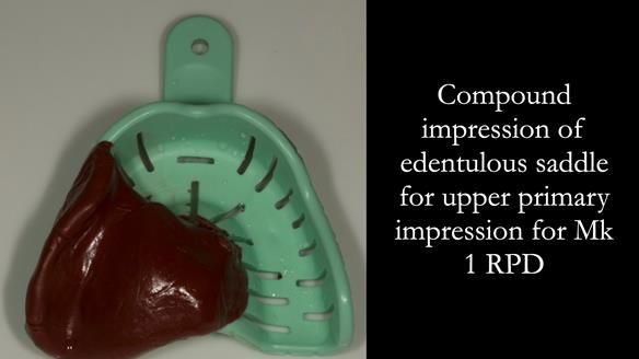 Finlay's Case Study Newsletter 40 - Immediate Mk 1 RPD to Definitive Mk 2 RPD - full protocol