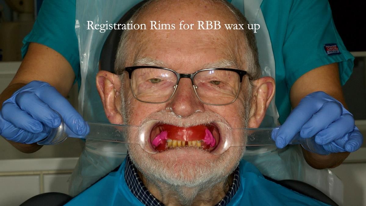 Newsletter 87 – Father Peter: A Partial Denture that needed Minor Miracle
