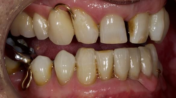 Newsletter 86 Peter the Architect — precision removable partial dentures case study