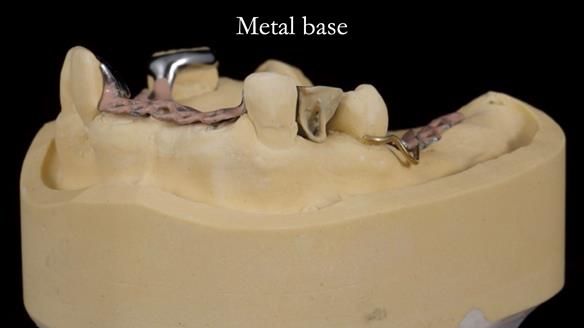 Managing Edgar “THE SCEPTIC” with an RPD/Splint FULL CASE