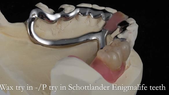 Newsletter 54 case presentation upper complete denture and lower Scandinavian designed hygienic partial denture for David