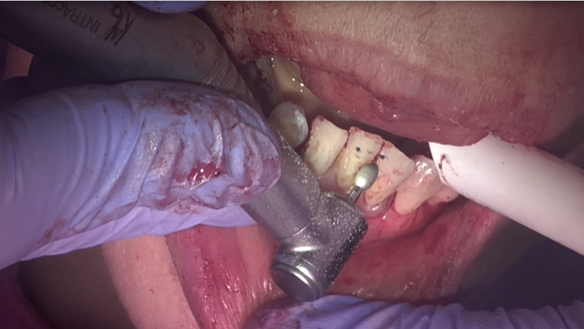 Figure 41 Occlusion adjusted so that bite even on all of prosthetic teeth. In this case the bite was propped open on the the immediate dentures owing to a lack of space in ICP