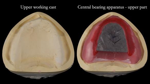 Newsletter 82 Mary - A complete upper and a one-tooth gasket denture