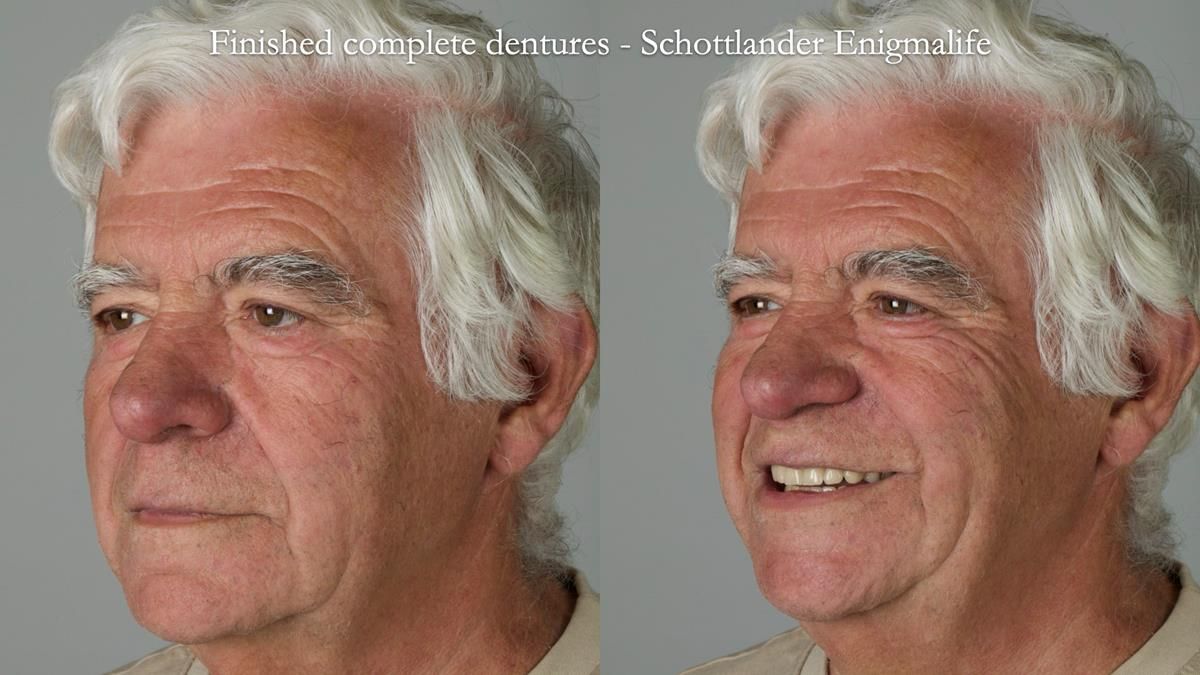 Fin’s Newsletter 88 — Complete dentures - full protocol… he rearranged his own teeth!