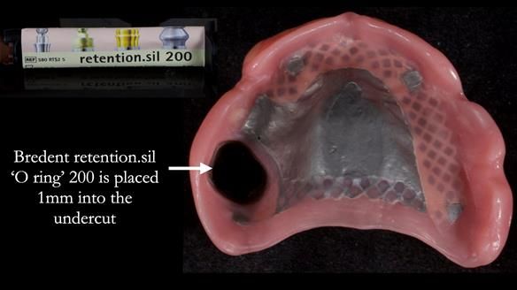 Finlay's Newsletter 58 Gasket upper partial denture for Zoe
