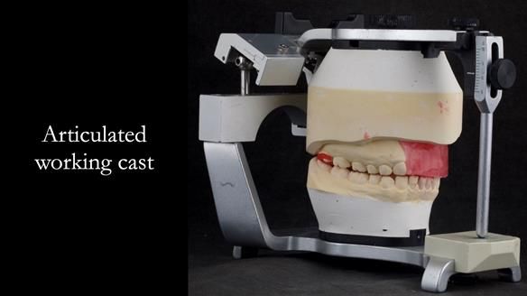 Upper metal base partial denture/occlusal stabilisation splint/obturator - full protocol