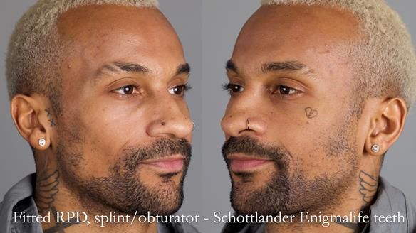 Upper metal base partial denture/occlusal stabilisation splint/obturator - full protocol