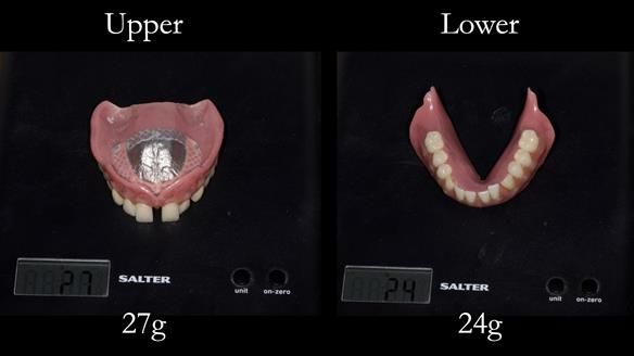 Newsletter 53 showing the making and fitting of ultra life-like dentures for Valena