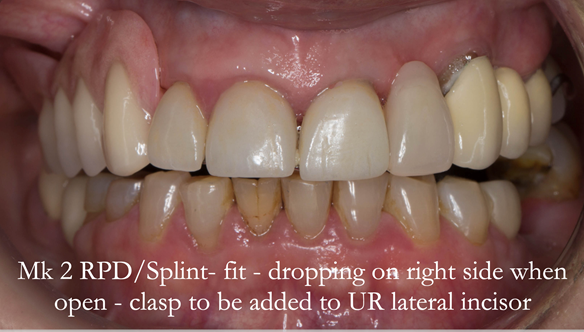 Newsletter 51 Managing Anne’s failing dentition with distal extension base RPD/Splint FULL PROTOCOL