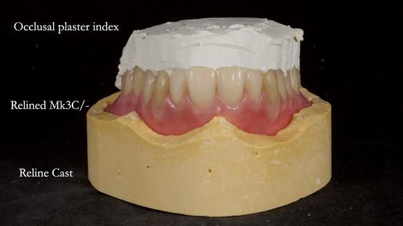 Newsletter 77: Jeremy’s case – immediate complete upper denture
