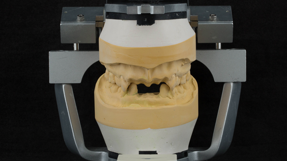 Figure 19 Mounted working cast for Mk 1 immediate denture. Teeth removed from cast - minimal preparation of the cast to reduce adjustments at fit