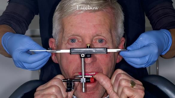 Newsletter 77: Jeremy’s case – immediate complete upper denture