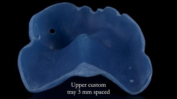 Newsletter 55 Provision of metal based partial dentures for Zephyrine with a repaired cleft lip and palate