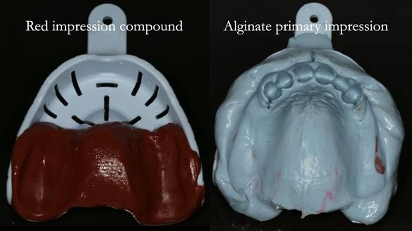 Newsletter 76: Jackie’s case – Telescopic overdenture & precision RPD (the tricky truth!)