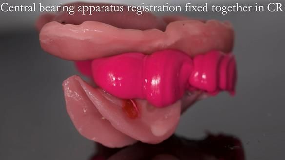 Newsletter 54 case presentation upper complete denture and lower Scandinavian designed hygienic partial denture for David