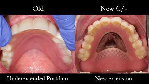 Newsletter 54 case presentation upper complete denture and lower Scandinavian designed hygienic partial denture for David