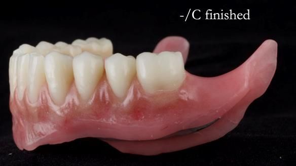 Managing poor implant positioning with complete dentures and Locator attachments - full protocol Newsletter 41