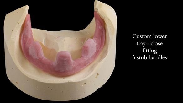 Replacing Madeline’s Complete denture FULL PROTOCOL