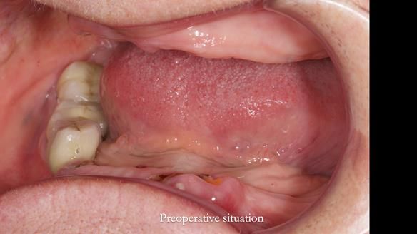 Newsletter 82 Mary - A complete upper and a one-tooth gasket denture