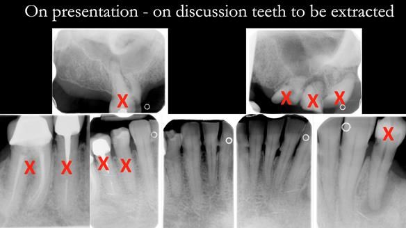 Newsletter 52 Managing Jo’s failing dentition with extractions and Mk 1/Mk 2 complete upper dentures and lower partial dentures FULL PROTOCOL